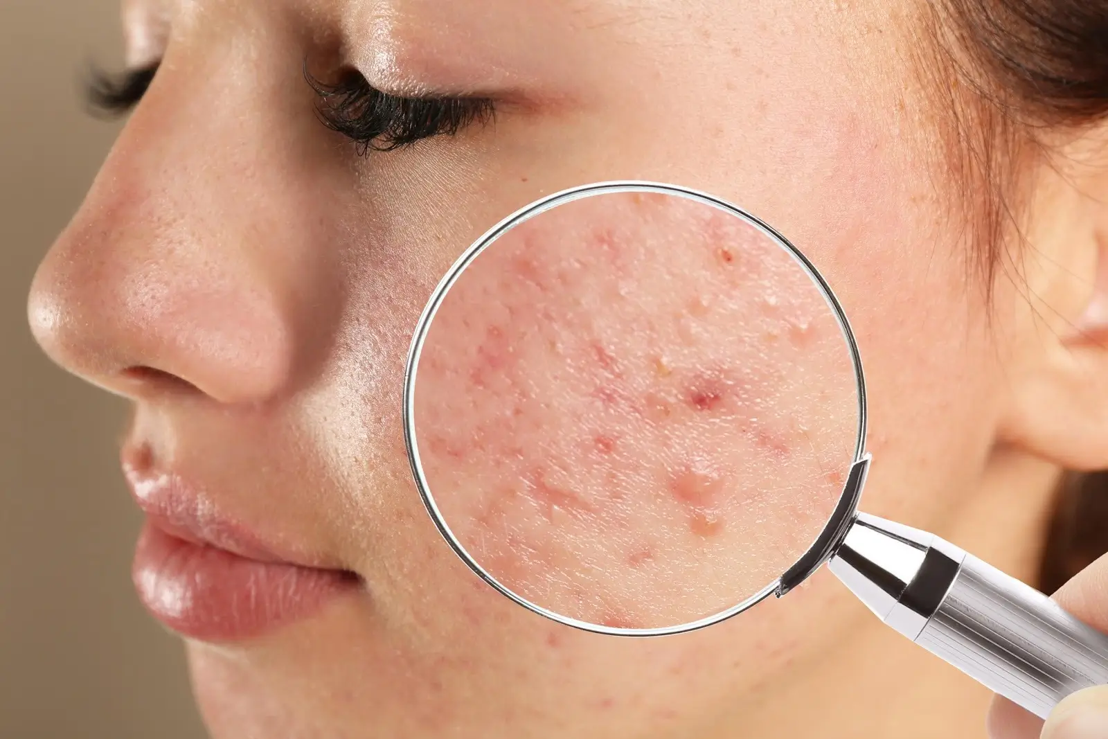Acne Scar Revision
