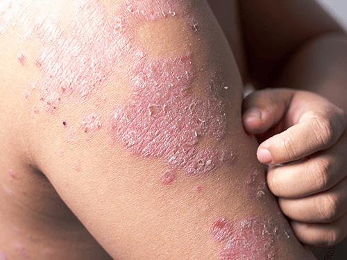 Eczema/Dermatitis