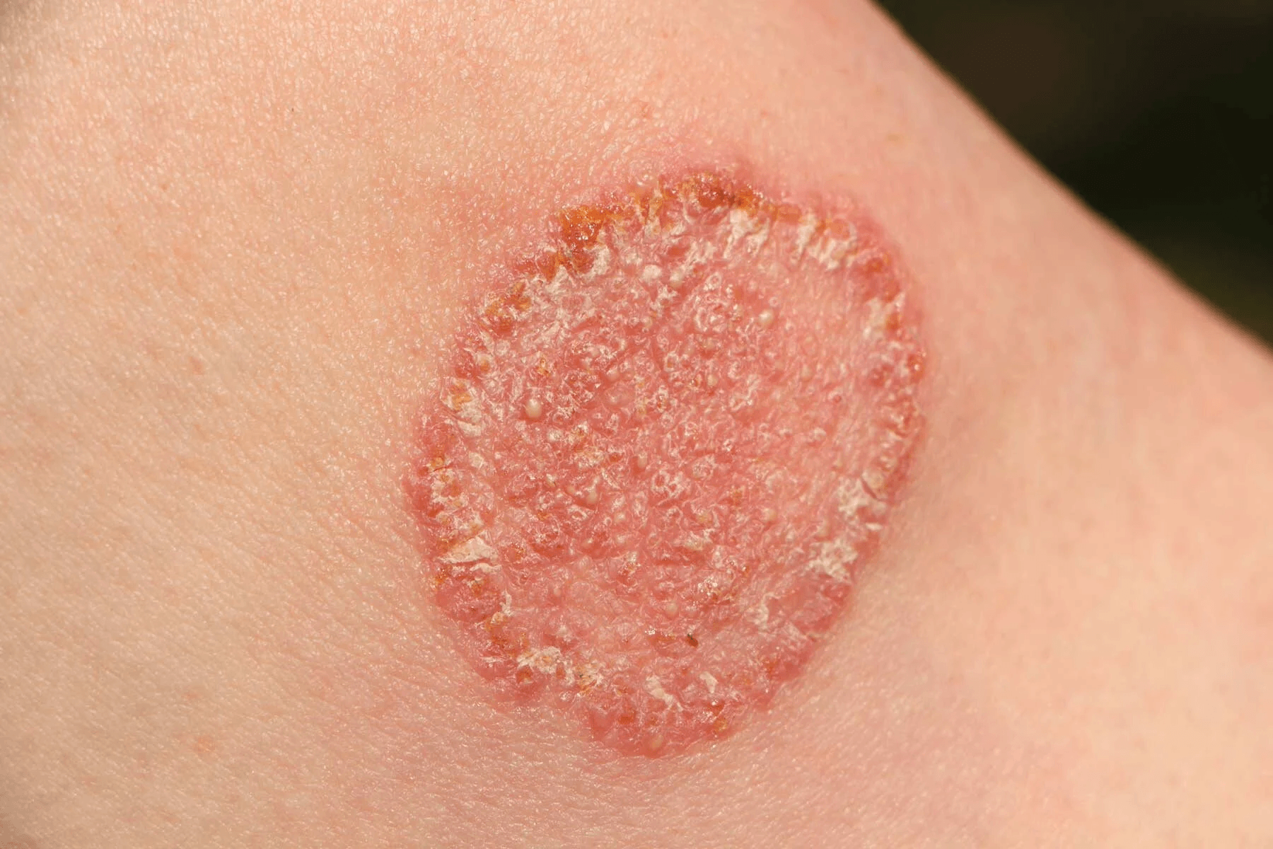 Fungal Infections