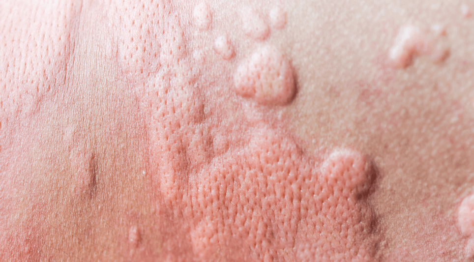 Skin Allergies