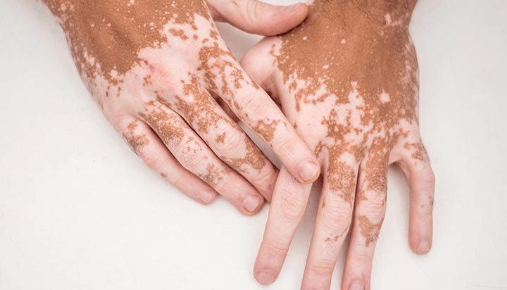 Pigmentation Disorders