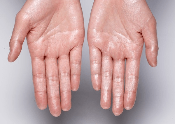 Hyperhidrosis
