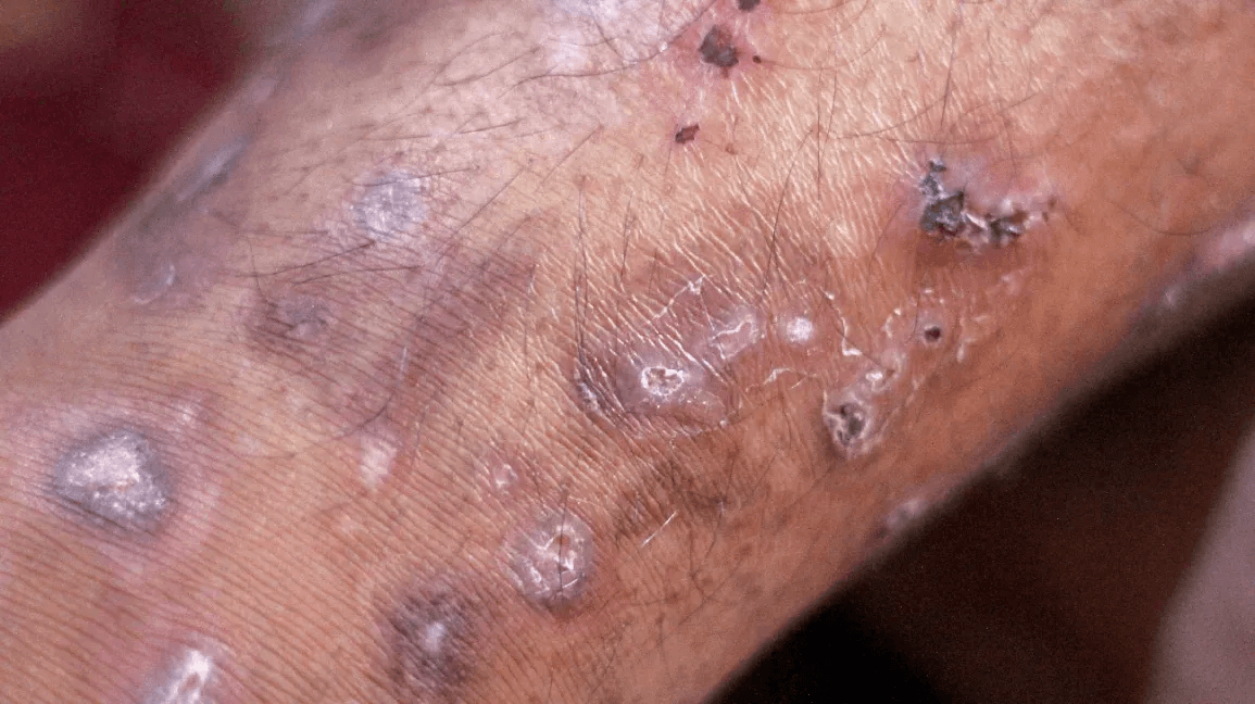 Chronic Itching