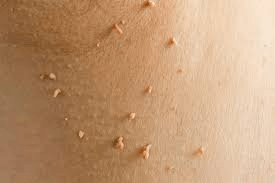 Skin Growths