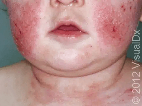 Childhood Eczema