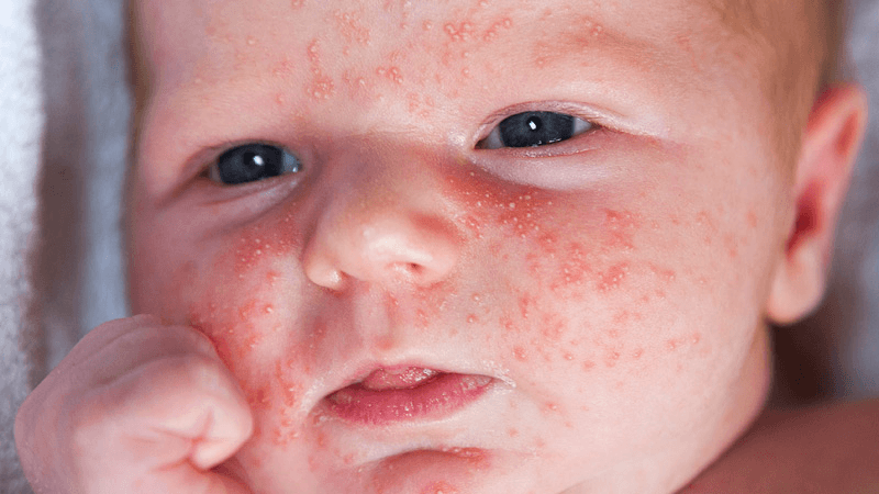 Pediatric Acne