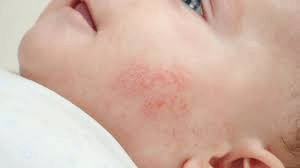 Infant Skin Conditions