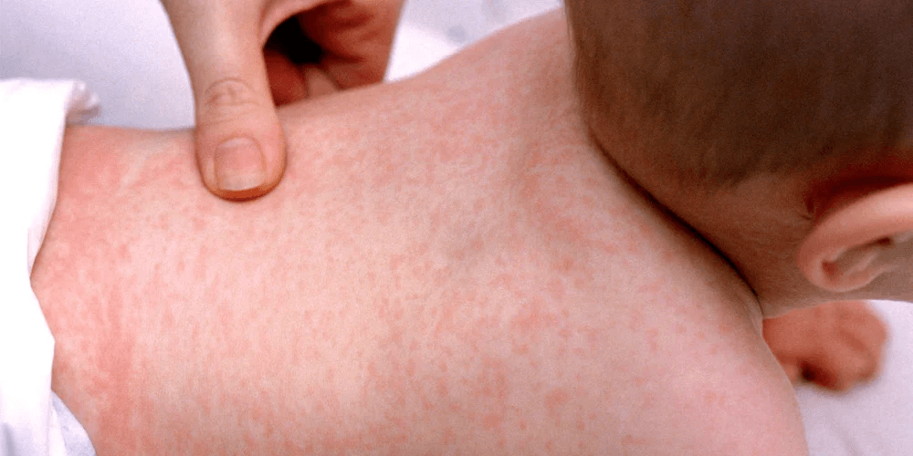 Rashes