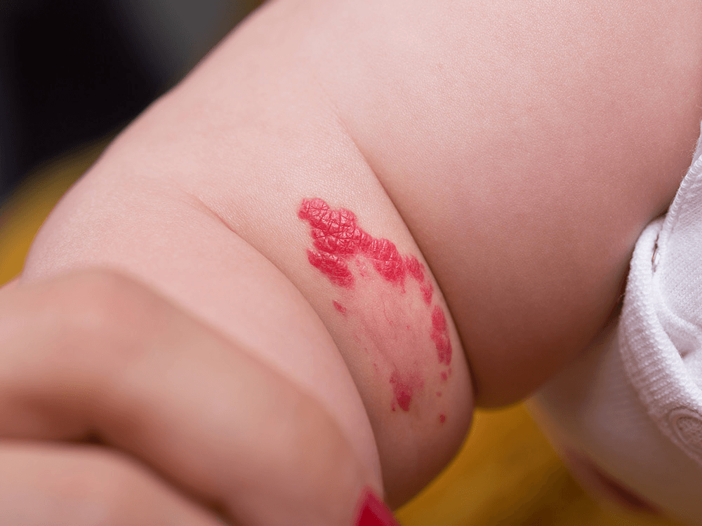 Birthmarks