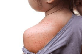 Skin Allergies