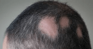 Alopecia