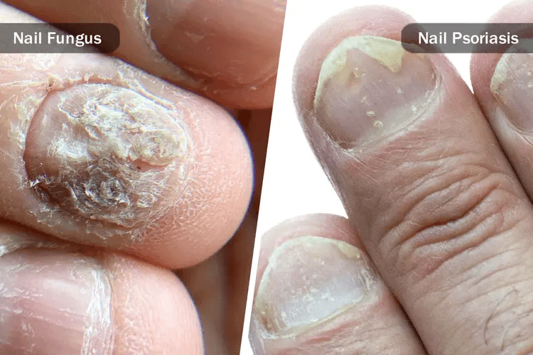 Nail Fungus