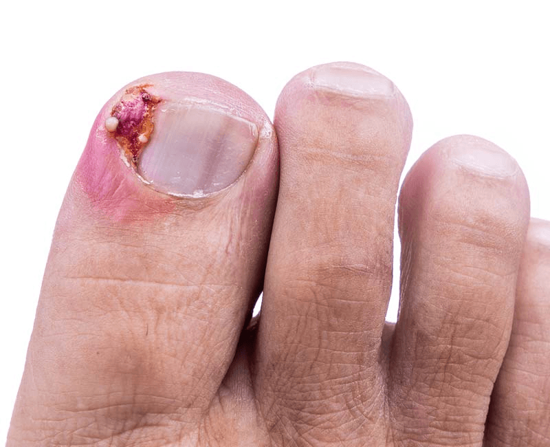 Ingrown Nails