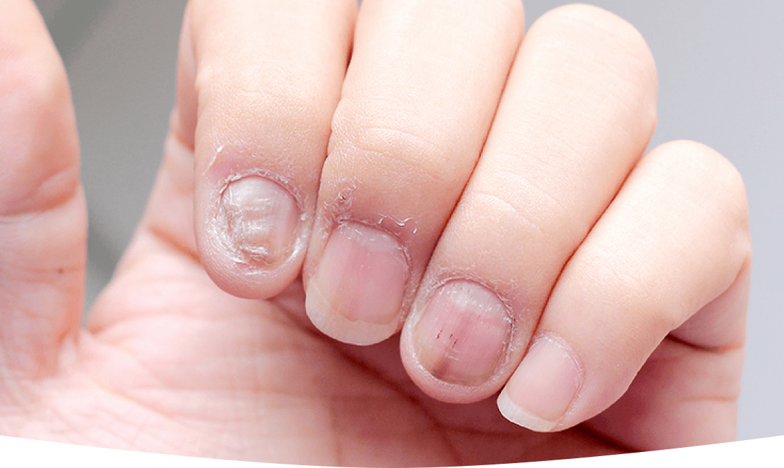Nail Infections
