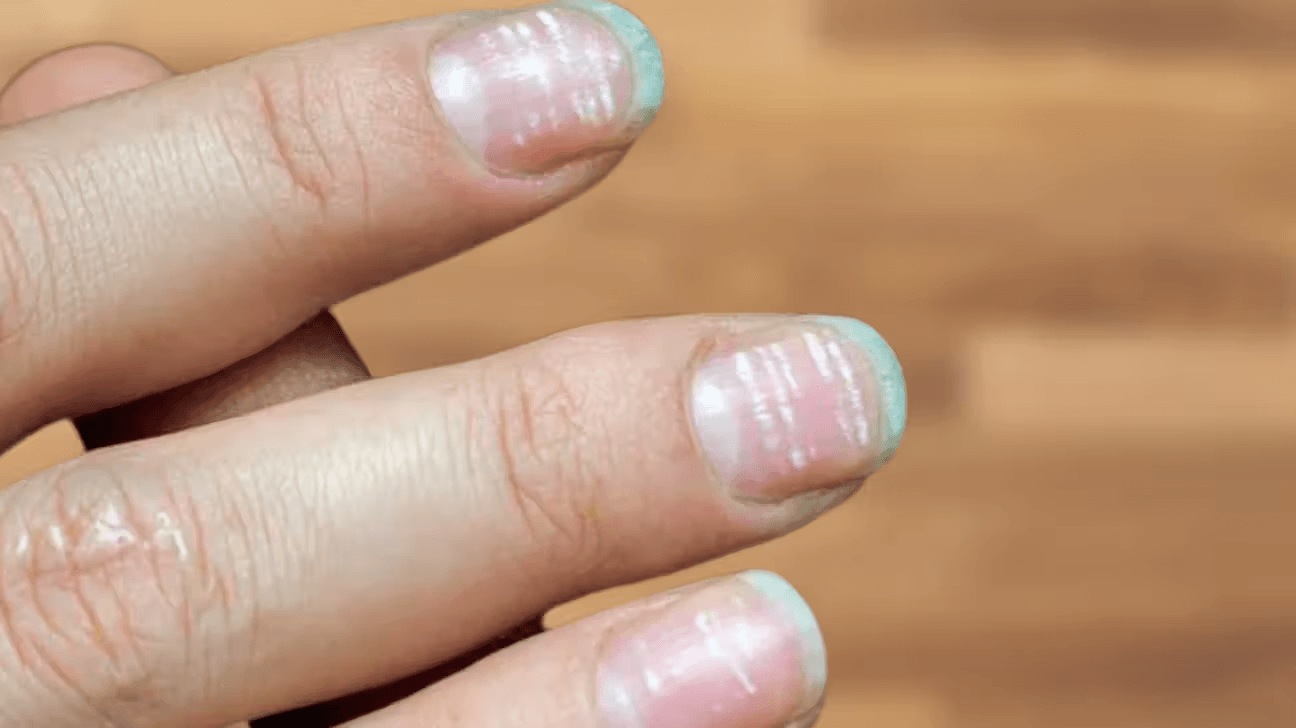 Nail Deformities