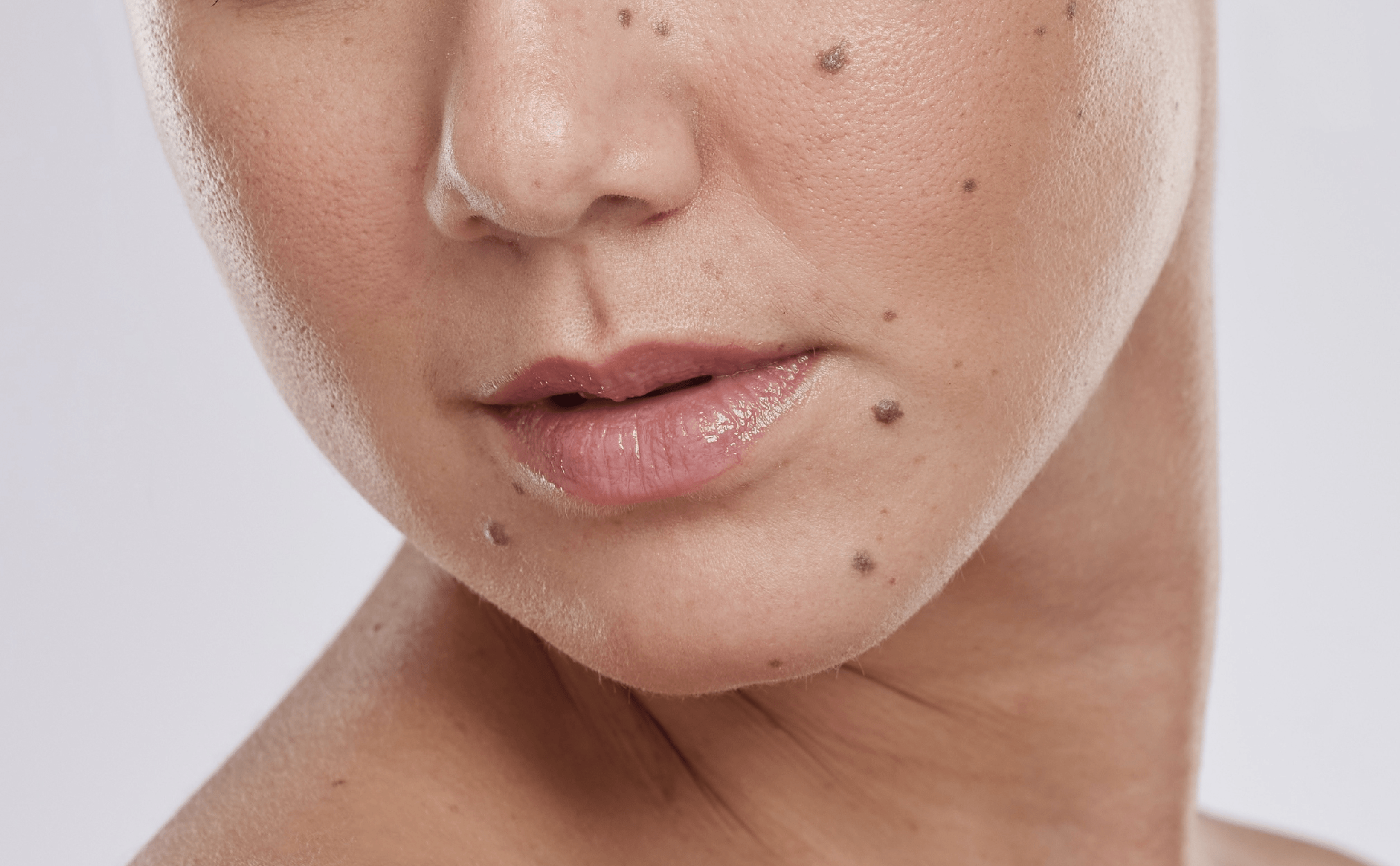 Mole Removal