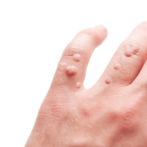 Warts Removal
