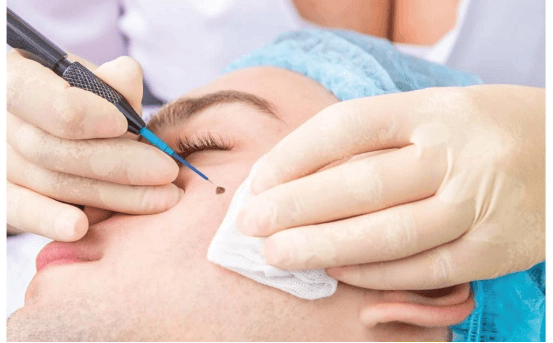 Electrocautery