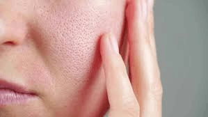 Pore Refinement