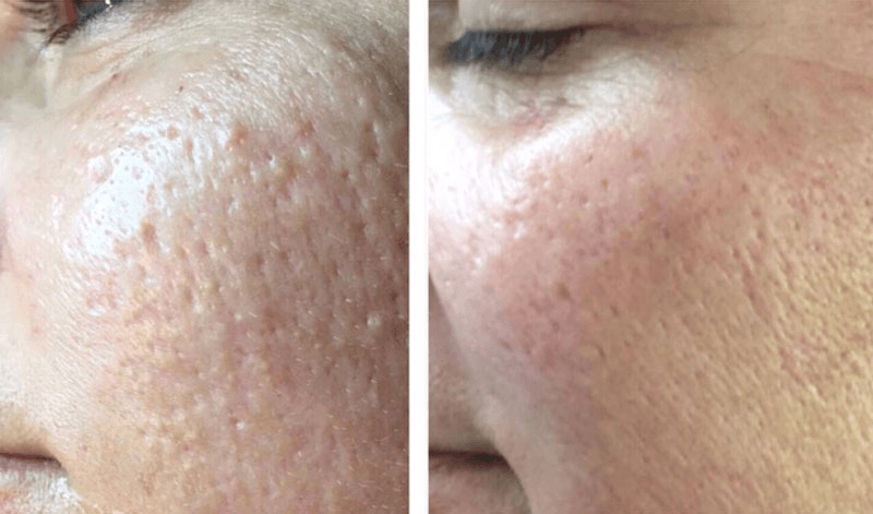 Skin Texture Improvement