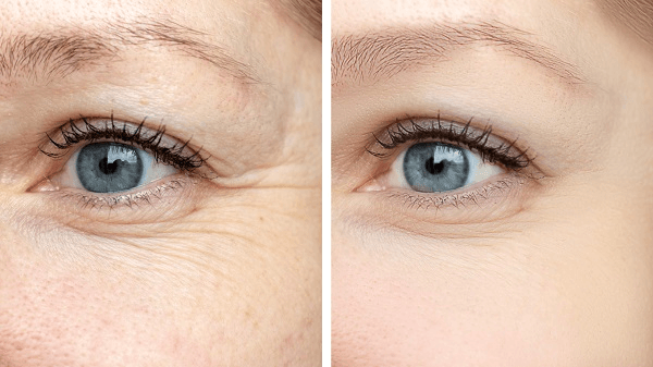 Wrinkle Reduction