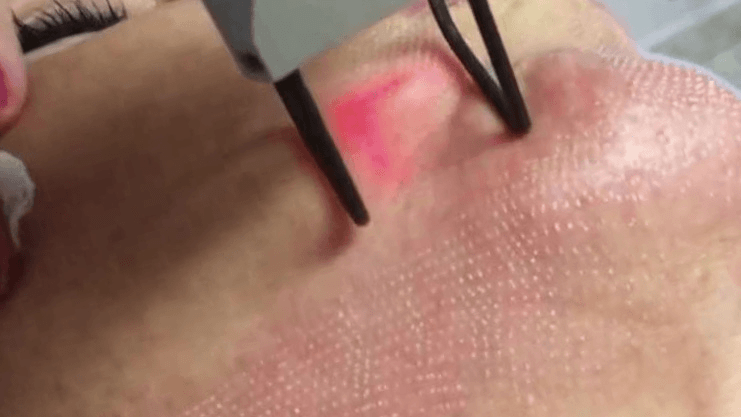 Fractional Laser