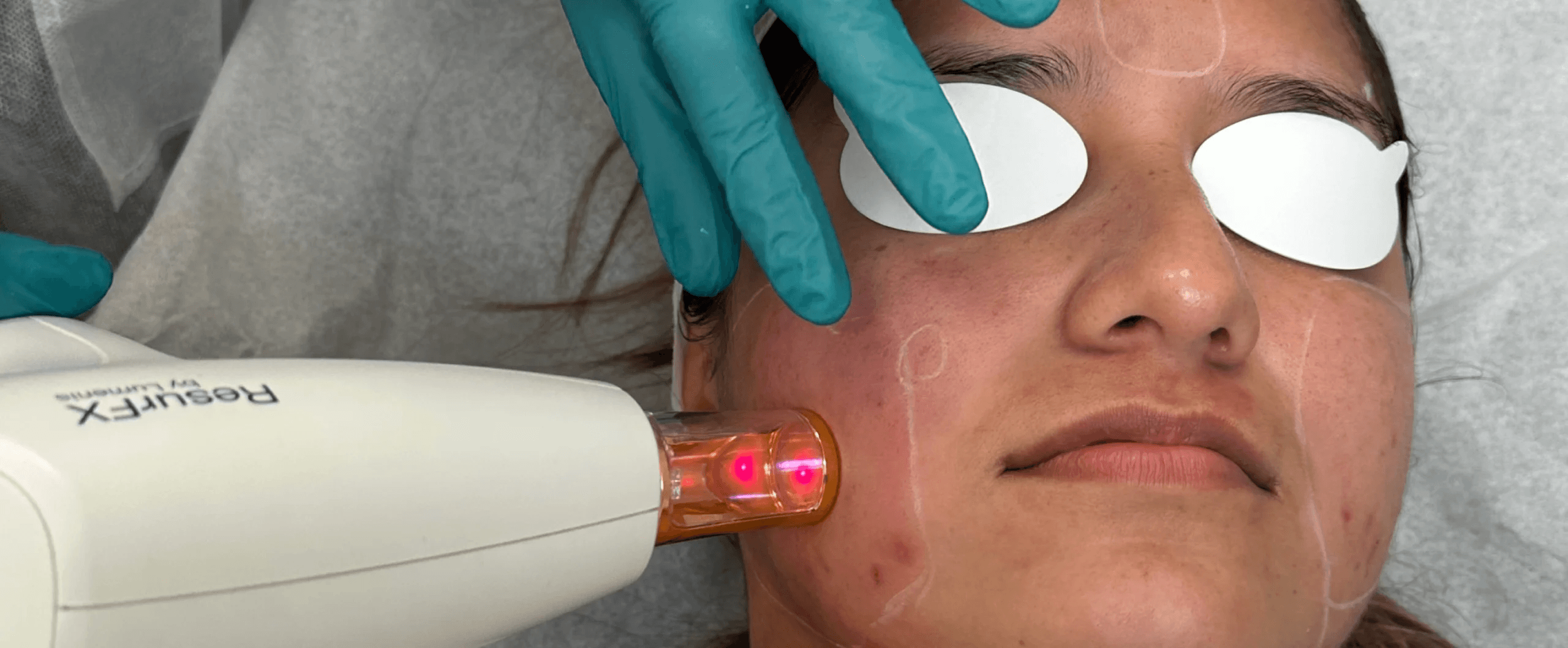 Laser Rejuvenation