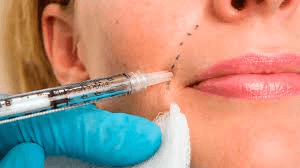 Derma Fillers