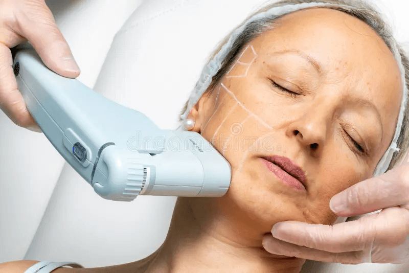 RF Microneedling
