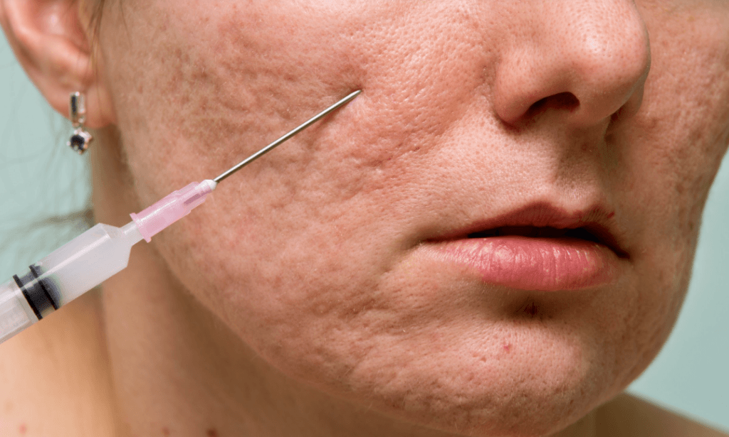 Subcision Treatment