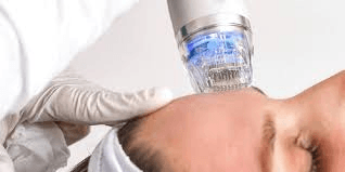 RF Microneedling