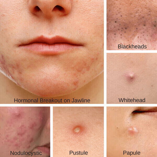 Types of Acne