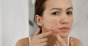 Acne Treatments