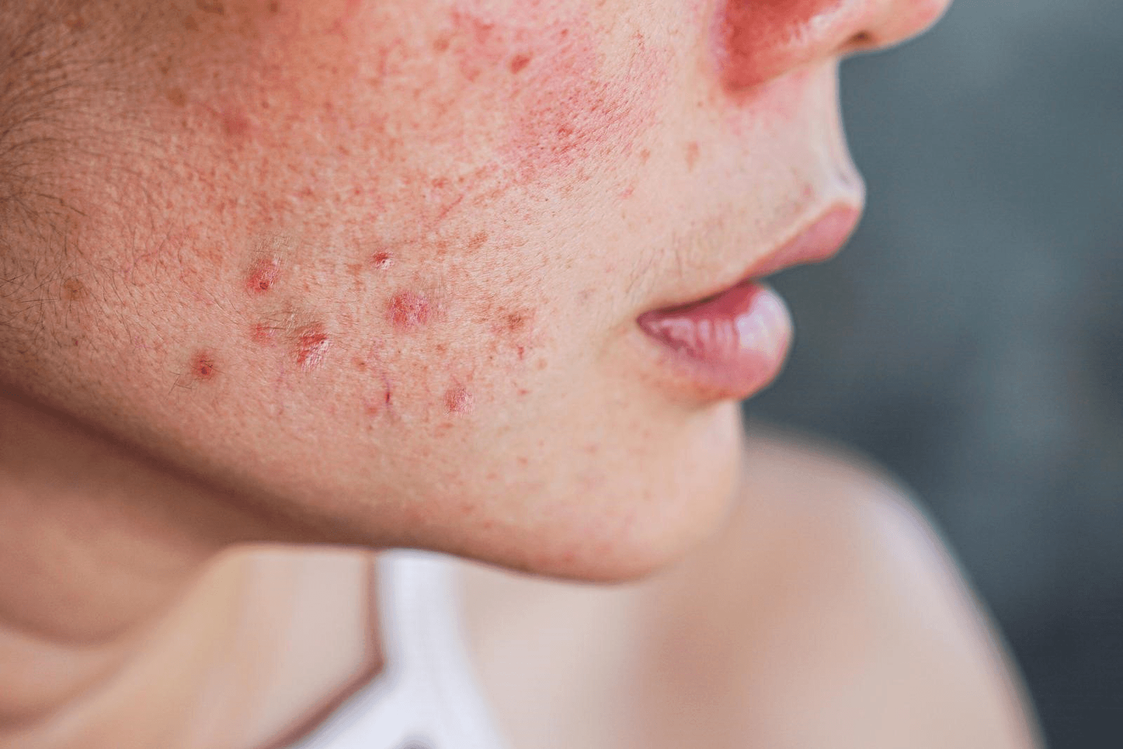 Acne FAQS