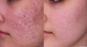 Combination Treatments