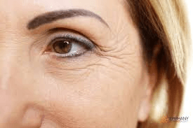 Wrinkles