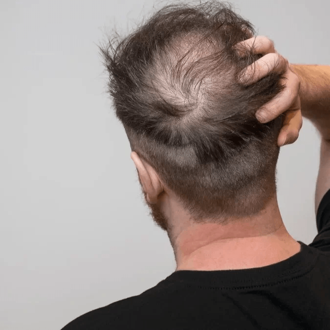 Hair Loss in Men