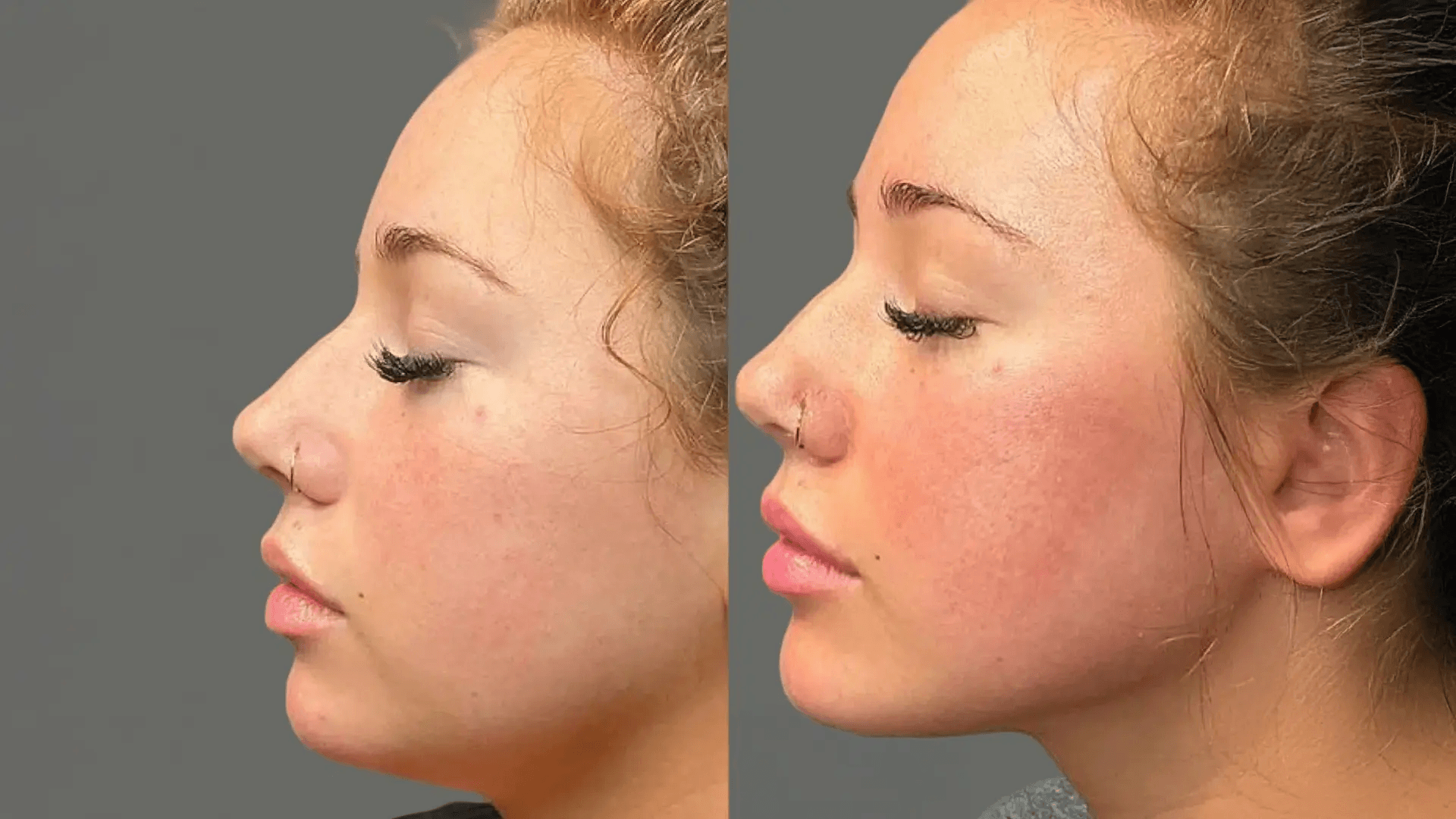 Jawline Contouring