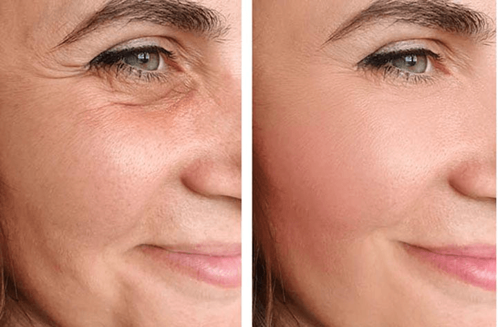 Non-Surgical Tightening