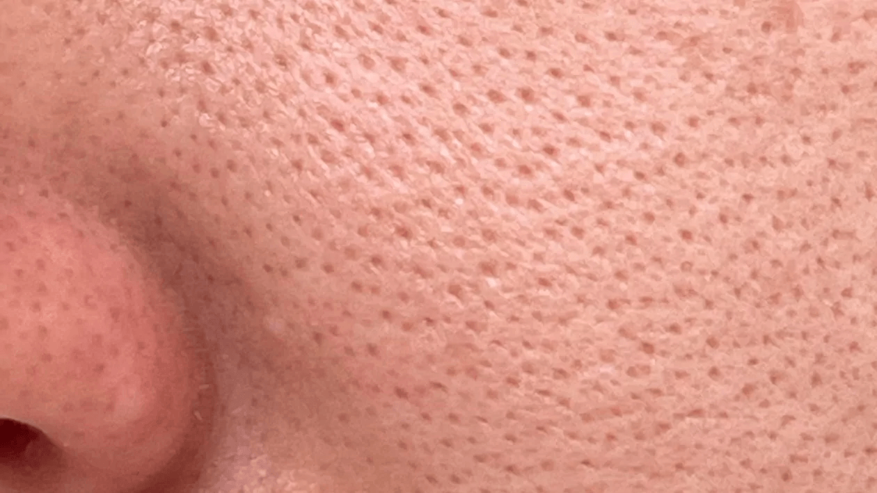 Enlarged Pores