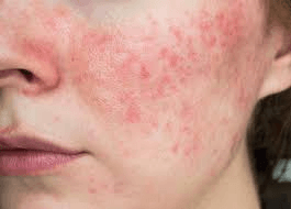 Sensitive Skin