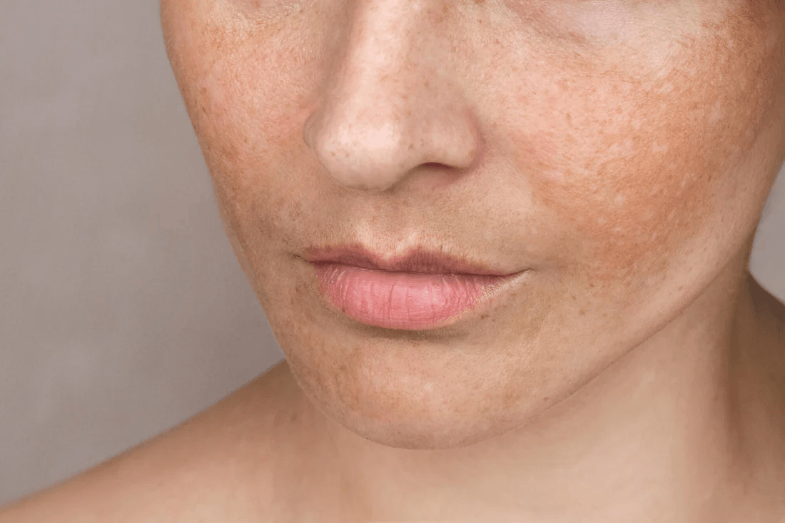 Uneven Skin Tone