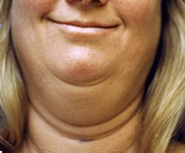 Double Chin